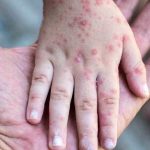 monkeypox